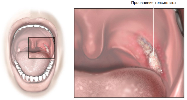Проявление тонзиллита во рту