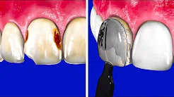 Серебрение зубов