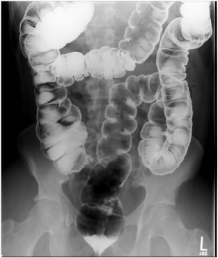 Снимок ирригоскопии